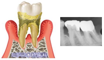 末期の歯周病