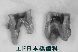 歯の補強
