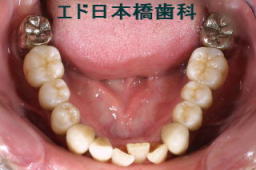 下顎インプラント5本術後