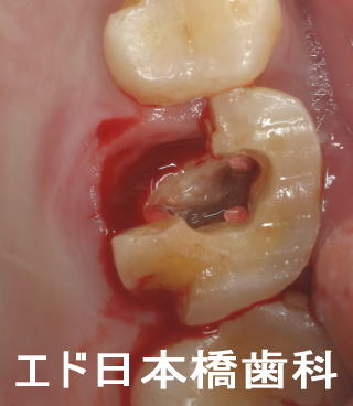 歯が割れる 歯根破折 歯根にひび ３つの保存治療法とは 東京都中央区 エド日本橋歯科