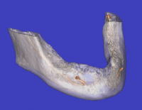 歯槽骨