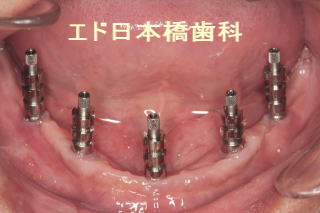 インプラント手術