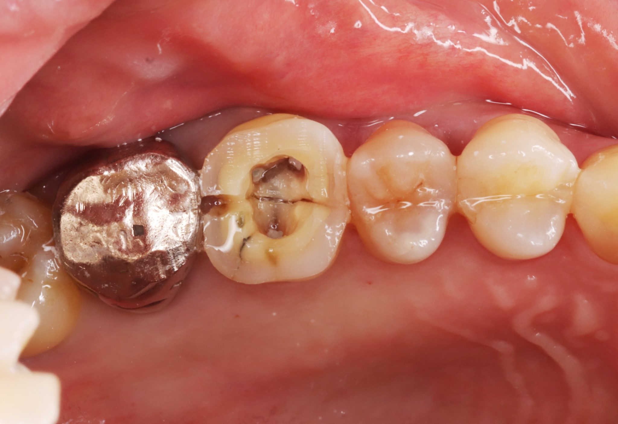 歯 が 根元 から 折れ た 放置