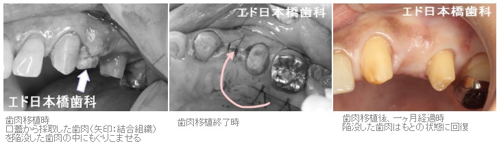 歯肉移植ブリッジ症例2