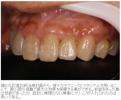 抜歯窩保存術を行ったブリッジ症例5