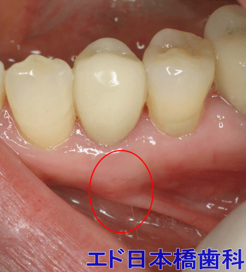 抜歯 奥歯 実体験、奥歯上下左右抜歯後の処置、食事や生活への影響！