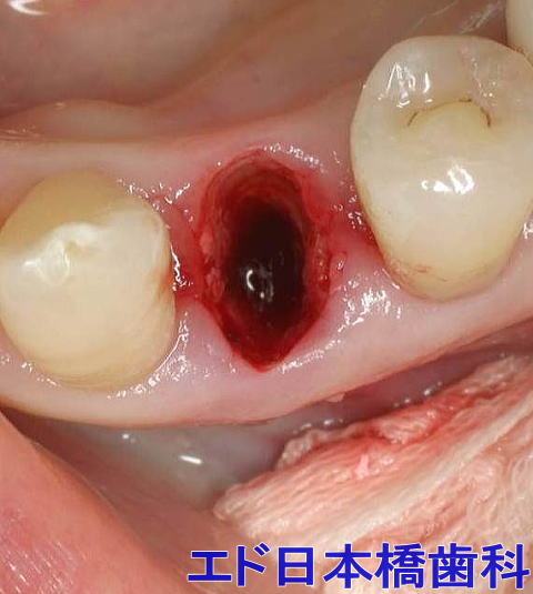 奥歯 の 奥 腫れ