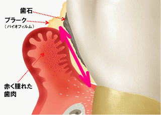 PDT(光線力学量)の適応症