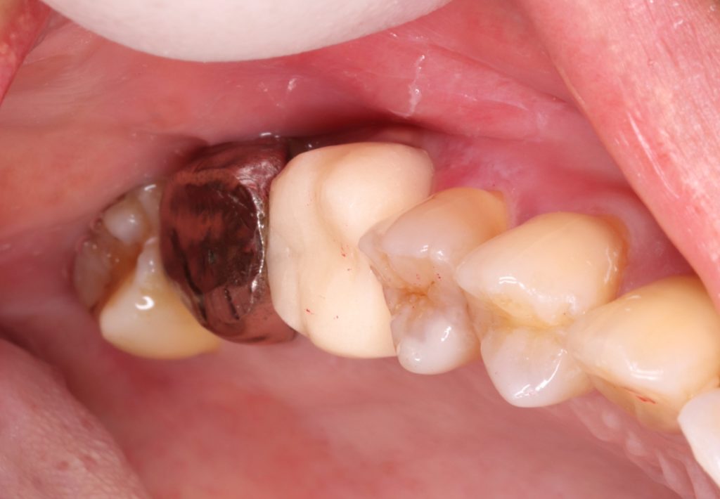 歯 が 割れ た 治療